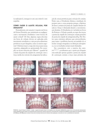 BRANDÃO, R. C. B.; BRANDÃO, L. B. C.
R Dental Press Ortodon Ortop Facial 149 Maringá, v. 13, n. 3, p. 124-156, maio/jun. 2008
to indesejável, consegue-se um caso estável e sem
seqüelas.
COMO FAZER O AJUSTE OCLUSAL POR
DESGASTE?
Normalmente,este assunto é exposto em livros
de Prótese Dentária, que minimizam ou negligen-
ciam o movimento ortodôntico como técnica de
ajuste oclusal8
. De fato, algumas regras descritas
em livros de oclusão devem ser aplicadas pelo
movimento ortodôntico, e não por procedimentos
protéticos ou por desgastes, como os autores suge-
rem8
. Podemos trazer a regra dos terços para nossa
expertise, adaptando ou aprimorando. Por exem-
plo, na técnica descrita por Okeson27
, quando há
contato da ponta da cúspide de contenção com o
terço médio da vertente do antagonista há indica-
ção de coroas protéticas para correção do contato.
Neste caso, a Ortodontia elimina a mutilação do
preparo para a coroa proposta porque a hipótese
de haver contatos de ponta de cúspide distante de
sulcos e fossas é eliminada durante a movimenta-
ção dentária.A Ortodontia só é incluída nos livros
de Próteses e Oclusão quando, na regra dos terços,
a ponta da cúspide de contenção contata próximo
da ponta da cúspide do antagonista (Fig. 28). Nes-
tes casos extremos sabemos que, provavelmente,
para tratar o problema haveria necessidade de se
incluir cirurgia ortognática ou distração osteogêni-
ca, ou os resultados seriam muito limitados.
Em consonância com a maioria dos auto-
res19,20,22,27
, acreditamos que o ajuste por desgaste
está indicado apenas quando a ponta da cúspide
de contenção contata o terço mais próximo da
A B C
D E F
G H
FIGURA 24 - Caso 8: Classe II, divisão 1, tratada - seguida de ajuste oclusal, com seqüência em articulador. A, B, C) Má oclusão inicial, com protrusão dentoalveolar
superior. D, E, F) Paciente tratada com exodontias dos primeiros pré-molares superiores, alcançando bom resultado final. G, H) Seis meses depois do tratamento,o desvio
de RC (G) para MIH (H) gerava contatos fortes entre os dentes anteriores em máxima intercuspidação, colocando em risco a estabilidade do tratamento.
 