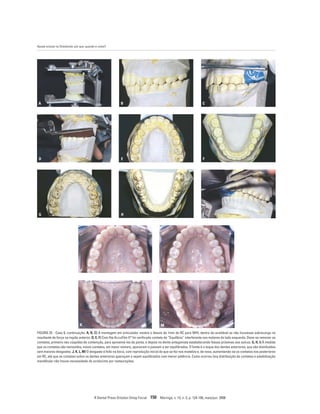 Ajuste oclusal na Ortodontia: por que, quando e como?
R Dental Press Ortodon Ortop Facial 150 Maringá, v. 13, n. 3, p. 124-156, maio/jun. 2008
D E F
G H I
J
K
L
M
A B C
FIGURA 25 - Caso 8, continuação. A, B, C) A montagem em articulador mostra o desvio de 1mm de RC para MIH, dentro do aceitável se não houvesse sobrecarga na
resultante de força na região anterior. D, E, F) Com fita AccuFilm II®
foi verificado contato de “Equilíbrio” interferente nos molares do lado esquerdo. Deve-se remover os
contatos, primeiro nas cúspides de contenção, para aproximá-los da ponta, e depois no dente antagonista estabelecendo fossas próximas aos sulcos. G, H, I) À medida
que os contatos são removidos, novos contatos, em maior número, aparecem e passam a ser equilibrados. O limite é o toque dos dentes anteriores, que são distribuídos
sem maiores desgastes. J, K, L, M) O desgaste é feito na boca, com reprodução inicial do que se fez nos modelos e, de novo, aumentando-se os contatos nos posteriores
em RC, até que os contatos sobre os dentes anteriores apareçam e sejam equilibrados com menor potência. Como ocorreu boa distribuição de contatos e estabilização
mandibular não houve necessidade de acréscimo por restaurações.
 