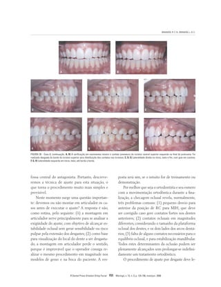 BRANDÃO, R. C. B.; BRANDÃO, L. B. C.
R Dental Press Ortodon Ortop Facial 151 Maringá, v. 13, n. 3, p. 124-156, maio/jun. 2008
A B
C
F
D
G
E
H
FIGURA 26 - Caso 8, continuação. A, B) A verificação em movimentos mostra o contato prematuro do incisivo central superior esquerdo no final da protrusiva. Foi
realizado desgaste do bordo do incisivo superior para distribuição dos contatos nos incisivos. C, D, E) Lateralidade direita no início, meio e fim, com guia em caninos.
F, G, H) Lateralidade esquerda em início, meio, até borda a borda.
posta será sim, se o intuito for de treinamento ou
demonstração.
Por melhor que seja o ortodontista e seu esmero
com a movimentação ortodôntica durante a fina-
lização, a checagem oclusal revela, normalmente,
três problemas comuns: (1) pequeno desvio para
anterior da posição de RC para MIH, que deve
ser corrigido caso gere contatos fortes nos dentes
anteriores; (2) contatos oclusais em magnitudes
diferentes, considerando o tamanho da plataforma
oclusal dos dentes, e os dois lados dos arcos dentá-
rios; (3) falta de alguns contatos necessários para o
equilíbrio oclusal, e para estabilização mandibular.
Todos estes determinantes da oclusão podem ser
plenamente alcançados sem prolongar-se indefini-
damente um tratamento ortodôntico.
O procedimento de ajuste por desgaste deve le-
fossa central do antagonista. Portanto, descreve-
remos a técnica de ajuste para esta situação, o
que torna o procedimento muito mais simples e
previsível.
Neste momento surge uma questão importan-
te: devemos ou não montar em articulador os ca-
sos antes de executar o ajuste? A resposta é não,
como rotina, pelo seguinte: (1) a montagem em
articulador serve principalmente para se analisar a
exigüidade do ajuste, com objetivo de alcançar es-
tabilidade oclusal sem gerar sensibilidade ou risco
pulpar pela extensão dos desgastes; (2) como base
para visualização do local do dente a ser desgasta-
do, a montagem em articulador perde o sentido,
porque é improvável que o operador consiga re-
alizar o mesmo procedimento em magnitude nos
modelos de gesso e na boca do paciente. A res-
 