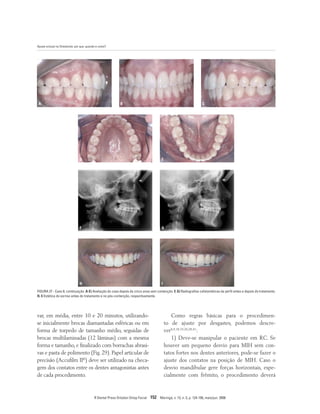 Ajuste oclusal na Ortodontia: por que, quando e como?
R Dental Press Ortodon Ortop Facial 152 Maringá, v. 13, n. 3, p. 124-156, maio/jun. 2008
FIGURA 27 - Caso 8, continuação. A-E) Avaliação do caso depois de cinco anos sem contenção. F, G) Radiografias cefalométicas de perfil antes e depois do tratamento.
H, I) Estética do sorriso antes do tratamento e no pós-contenção, respectivamente.
A B
D
F
H
E
G
I
C
Como regras básicas para o procedimen-
to de ajuste por desgastes, podemos descre-
ver8,9,18,19,20,28,41
:
1) Deve-se manipular o paciente em RC. Se
houver um pequeno desvio para MIH sem con-
tatos fortes nos dentes anteriores, pode-se fazer o
ajuste dos contatos na posição de MIH. Caso o
desvio mandibular gere forças horizontais, espe-
cialmente com frêmito, o procedimento deverá
var, em média, entre 10 e 20 minutos, utilizando-
se inicialmente brocas diamantadas esféricas ou em
forma de torpedo de tamanho médio, seguidas de
brocas multilaminadas (12 lâminas) com a mesma
forma e tamanho, e finalizado com borrachas abrasi-
vas e pasta de polimento (Fig. 29). Papel articular de
precisão (Accufilm II®
) deve ser utilizado na checa-
gem dos contatos entre os dentes antagonistas antes
de cada procedimento.
 