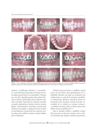 Ajuste oclusal na Ortodontia: por que, quando e como?
R Dental Press Ortodon Ortop Facial 126 Maringá, v. 13, n. 3, p. 124-156, maio/jun. 2008
A
F
I
B
G
J
C
D E
H
K
FIGURA 1 - Caso 1: apinhamento dentário sem extrações. A-E) Caso inicial: apinhamento dentário acentuado no arco superior. F, G, H) Tratamento com aparelho
extrabucal para ganho de espaço, sucedido de aparelho fixo. I, J, K) Resultado final, com bom aspecto morfológico da oclusão dentária.
Portanto, devemos buscar o equilíbrio oclusal
como um dos fatores para determinação da es-
tabilidade dentária, que pode ser alcançada com
conhecimento e controle da mecânica ortodônti-
ca. Movimentos dentários específicos devem ser
orientados pela checagem oclusal, havendo ne-
cessidade de se conhecer os contatos oclusais e
a resultante de forças sobre os dentes, para então
definir meios de modificá-los17,18
.
Para se entender melhor o equilíbrio oclusal,
descreveremos os tipos de contatos entre os pla-
nos inclinados das cúspides dos dentes posteriores,
sustenta a estabilização dentária é a musculatu-
ra13
, pois alterações de pressão por função muscu-
lar atípica geram forças em intensidade e duração
que vão além daquelas geradas pela oclusão den-
tária excelente e pela higidez óssea. Podemos citar
como exemplo: hipertonia do músculo mentalis,
causando apinhamento dentário inferior; postura
lingual constantemente projetada, promovendo
abertura da mordida; e respiração bucal, levando
ao estreitamento e projeção do arco superior, mes-
mo diante dos melhores contatos oclusais obtidos
pelo ortodontista.
 