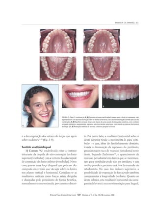 BRANDÃO, R. C. B.; BRANDÃO, L. B. C.
R Dental Press Ortodon Ortop Facial 127 Maringá, v. 13, n. 3, p. 124-156, maio/jun. 2008
A C
B D
FIGURA 2 - Caso 1, continuação. A, B) Contatos oclusais verificados 6 meses após o final do tratamento, não
equilibrados e com excesso de força sobre os dentes anteriores, risco de movimentação contida pelo uso de
contenções. C, D) Equilíbrio oclusal alcançado depois de uma sessão de desgastes seletivos, com contatos
oclusais múltiplos e equipotentes, menores sobre os dentes anteriores, controlando os vetores horizontais
de força. E, F, G) Avaliação estética do sorriso, contorno gengival e incisal.
E
F G
e a decomposição dos vetores de forças que agem
sobre os dentes19,20
(Fig. 3-9).
Sentido vestibulolingual
1) Contato “A”: estabelecido entre a vertente
triturante da cúspide de não-contenção do dente
superior (vestibular) com a vertente lisa da cúspide
de contenção do dente inferior (vestibular). Neste
caso, gera-se uma força diagonal que pode ser de-
composta em vetores que vão agir sobre os dentes
nos planos vertical e horizontal. Considera-se as
resultantes verticais como forças axiais, dirigidas
e dissipadas pelo periodonto de forma benéfica,
normalmente como estímulo, previamente descri-
to. Por outro lado, a resultante horizontal sobre o
dente superior tende a movimentá-lo para vesti-
bular - o que, além do desalinhamento dentário,
levaria à diminuição da espessura do peridonto,
gerando maior risco de recessão periodontal neste
dente. Segundo Zachrisson42
, o aparecimento da
recessão periodontal em dentes que se movimen-
tam para vestibular pode não ser imediato, e sim
tardio, quando o paciente está fora do controle do
ortodontista. No caso dos molares superiores, a
possibilidade de exposição de furca pode também
comprometer a longevidade do dente. Quanto ao
dente inferior, esta resultante horizontal não anta-
gonizada levaria à sua movimentação para lingual,
 