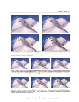 BRANDÃO, R. C. B.; BRANDÃO, L. B. C.
R Dental Press Ortodon Ortop Facial 129 Maringá, v. 13, n. 3, p. 124-156, maio/jun. 2008
FIGURA 4 - Contato “A”, direção da força oclusal e vetores de força. A) Direção de força pelo contato entre a vertente triturante da cúspide de não-contenção superior
com a vertente lisa da cúspide de contenção inferior; B) decomposição da força de oclusão em vetores axiais (amarelo) e horizontais (vermelho); C, D) vetores axiais são
dissipados pelo periodonto, restando os vetores horizontais que levariam à movimentação vestibular do dente superior e lingual do inferior, ou desvio mandibular para o
lado oposto (Imagens cedidas por Dr. Paulo Isaias Seraidarian).
FIGURA 5 - Contato “B”, direção da força oclusal e vetores de força: A) direção de força pelo contato entre a vertente triturante da cúspide de contenção superior com
a vertente triturante da cúspide de contenção inferior; B) decomposição da força de oclusão em vetores axiais (amarelo) e horizontais (vermelho); C) vetores horizontais
remanescentes que levariam à movimentação lingual do dente superior e vestibular do inferior, ou desvio mandibular para o mesmo lado. Note que os vetores remanes-
centes do contato “A” antagonizam os do contato “B” (Imagens cedidas por Dr. Paulo Isaias Seraidarian).
FIGURA 6 - Contato “C”, direção da força oclusal e vetores de força: A) direção de força pelo contato entre a vertente lisa da cúspide de contenção superior com a ver-
tente triturante da cúspide de não-contenção inferior; B) decomposição da força de oclusão em vetores axiais (amarelo) e horizontais (vermelho); C) vetores horizontais
remanescentes que levariam à movimentação análoga à do contato “A”. Ocorre o equilíbrio quando a soma dos vetores dos contatos “A” e “C” é antagonizada pelo
contato “B” (Imagens cedidas por Dr. Paulo Isaias Seraidarian).
B
A
C
B
A C
B
A C
D
 