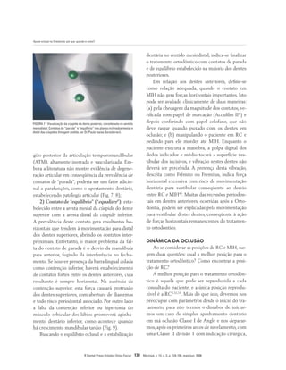 Ajuste oclusal na Ortodontia: por que, quando e como?
R Dental Press Ortodon Ortop Facial 130 Maringá, v. 13, n. 3, p. 124-156, maio/jun. 2008
gião posterior da articulação temporomandibular
(ATM), altamente inervada e vascularizada. Em-
bora a literatura não mostre evidência de degene-
ração articular em conseqüência da prevalência de
contatos de “parada”, poderia ser um fator adicio-
nal a parafunções, como o apertamento dentário,
estabelecendo patologia articular (Fig. 7, 8);
2) Contato de “equilíbrio” (“equalizer”): esta-
belecido entre a aresta mesial da cúspide do dente
superior com a aresta distal da cúspide inferior.
A prevalência deste contato gera resultantes ho-
rizontais que tendem à movimentação para distal
dos dentes superiores, abrindo os contatos inter-
proximais. Entretanto, o maior problema da fal-
ta do contato de parada é o desvio da mandíbula
para anterior, fugindo da interferência no fecha-
mento. Se houver presença da barra lingual colada
como contenção inferior, haverá estabelecimento
de contatos fortes entre os dentes anteriores, cuja
resultante é sempre horizontal. Na ausência da
contenção superior, esta força causará protrusão
dos dentes superiores, com abertura de diastemas
e todo risco periodontal associado. Por outro lado
a falta da contenção inferior ou hipertonia do
músculo orbicular dos lábios promoverá apinha-
mento dentário inferior, como acontece quando
há crescimento mandibular tardio (Fig. 9).
Buscando o equilíbrio oclusal e a estabilização
dentária no sentido mesiodistal, indica-se finalizar
o tratamento ortodôntico com contatos de parada
e de equilíbrio estabelecido na maioria dos dentes
posteriores.
Em relação aos dentes anteriores, define-se
como relação adequada, quando o contato em
MIH não gera forças horizontais importantes. Isto
pode ser avaliado clinicamente de duas maneiras:
(a) pela checagem da magnitude dos contatos, ve-
rificada com papel de marcação (Accufilm II®
) e
depois conferindo com papel celofane, que não
deve rasgar quando puxado com os dentes em
oclusão; e (b) manipulando o paciente em RC e
pedindo para ele morder até MIH. Enquanto o
paciente executa a manobra, a polpa digital dos
dedos indicador e médio tocará a superfície ves-
tibular dos incisivos, e vibração nestes dentes não
deverá ser percebida. A presença desta vibração,
descrita como Frêmito ou Fremitus, indica força
horizontal excessiva com risco de movimentação
dentária para vestibular conseqüente ao desvio
entre RC e MIH40
. Muitas das recessões periodon-
tais em dentes anteriores, ocorridas após a Orto-
dontia, podem ser explicadas pela movimentação
para vestibular destes dentes, conseqüente à ação
de forças horizontais remanescentes do tratamen-
to ortodôntico.
DINÂMICA DA OCLUSÃO
Ao se considerar as posições de RC e MIH, sur-
gem duas questões: qual a melhor posição para o
tratamento ortodôntico? Como encontrar a posi-
ção de RC?
A melhor posição para o tratamento ortodôn-
tico é aquela que pode ser reproduzida a cada
consulta do paciente, e a única posição reprodu-
zível é a RC4,32,33
. Mais do que isto, devemos nos
preocupar com parâmetros desde o início do tra-
tamento, para não termos o dissabor de iniciar-
mos um caso de simples apinhamento dentário
em má oclusão Classe I de Angle e nos deparar-
mos, após os primeiros arcos de nivelamento, com
uma Classe II divisão 1 com indicação cirúrgica,
FIGURA 7 - Visualização da cúspide de dente posterior, considerada no sentido
mesiodistal. Contatos de “parada” e “equilíbrio” nos planos inclinados mesial e
distal das cúspides (Imagem cedida por Dr. Paulo Isaias Seraidarian).
 