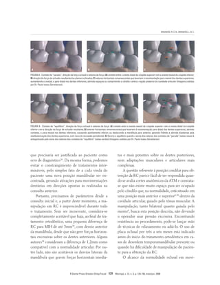 BRANDÃO, R. C. B.; BRANDÃO, L. B. C.
R Dental Press Ortodon Ortop Facial 131 Maringá, v. 13, n. 3, p. 124-156, maio/jun. 2008
que precisaria ser justificada ao paciente como
erro de diagnóstico36
. Da mesma forma, podemos
evitar o constrangimento de tratamentos inter-
mináveis, pelo simples fato de a cada vinda do
paciente uma nova posição mandibular ser en-
contrada, gerando ativações para movimentações
dentárias em direções opostas às realizadas na
consulta anterior.
Portanto, precisamos de parâmetros desde a
consulta inicial e, a partir deste momento, a ma-
nipulação em RC é imprescindível durante todo
o tratamento. Sem ser incoerente, considera-se
completamente aceitável que haja, ao final do tra-
tamento ortodôntico, uma pequena diferença de
RC para MIH de até 3mm38
, com desvio anterior
da mandíbula, desde que não gere forças horizon-
tais excessivas sobre os dentes anteriores. Alguns
autores38
consideram a diferença de 1,2mm como
compatível com a normalidade articular. Por ou-
tro lado, não são aceitáveis os desvios laterais da
mandíbula que gerem forças horizontais imedia-
tas e mais potentes sobre os dentes posteriores,
nem adaptações musculares e articulares mais
complexas.
A questão referente à posição condilar para ob-
tenção da RC parece fácil de ser respondida quan-
do se avalia cortes anatômicos da ATM e constata-
se que não existe muito espaço para ser ocupado
pelo côndilo que, na normalidade, está situado em
uma posição mais anterior e superior8,28
dentro da
cavidade articular, guiado pelo tônus muscular. A
manipulação, tanto bilateral quanto guiada pelo
mento8
, busca esta posição descrita, não devendo
o operador usar pressão excessiva. Encontrando
resistência ao procedimento, pode-se lançar mão
de técnicas de relaxamento ou adiá-lo. O uso de
placa oclusal por três a seis meses está indicado
antes do início do tratamento ortodôntico em ca-
sos de desordem temporomandibular presente ou
quando há dificuldade de manipulação do pacien-
te para a obtenção da RC.
O alcance da normalidade oclusal em movi-
FIGURA 8 - Contato de “parada”, direção da força oclusal e vetores de força: A) contato entre a aresta distal da cúspide superior com a aresta mesial da cúspide inferior;
B) direção da força de oclusão resultante dos planos inclinados; C) vetores horizontais remanescentes que levariam à movimentação para mesial dos dentes superiores,
aumentando o overjet, e para distal nos dentes inferiores, abrindo espaços ou comprimindo o côndilo contra a região posterior da cavidade articular (Imagens cedidas
por Dr. Paulo Isaias Seraidarian).
FIGURA 9 - Contato de “equilíbrio”, direção da força oclusal e vetores de força: A) contato entre a aresta mesial da cúspide superior com a aresta distal da cúspide
inferior com a direção da força de oclusão resultante; B) vetores horizontais remanescentes que levariam à movimentação para distal dos dentes superiores, abrindo
contatos, e para mesial nos dentes inferiores, causando apinhamento inferior, ou deslocando a mandíbula para anterior, gerando Frêmito e abrindo diastemas pela
vestibularização dos dentes superiores, com risco de recessão periodontal. C) Ocorre o equilíbrio quando a soma dos vetores dos contatos de “parada” (setas rosas) é
antagonizada pelo soma dos vetores dos contatos de “equilíbrio” (setas verdes) (Imagens cedidas por Dr. Paulo Isaias Seraidarian).
B
A C
B
A C
 