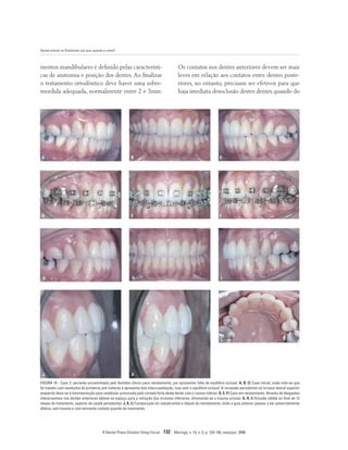 Ajuste oclusal na Ortodontia: por que, quando e como?
R Dental Press Ortodon Ortop Facial 132 Maringá, v. 13, n. 3, p. 124-156, maio/jun. 2008
mentos mandibulares é definido pelas característi-
cas de anatomia e posição dos dentes. Ao finalizar
o tratamento ortodôntico deve haver uma sobre-
mordida adequada, normalmente entre 2 e 3mm.
Os contatos nos dentes anteriores devem ser mais
leves em relação aos contatos entre dentes poste-
riores, no entanto, precisam ser efetivos para que
haja imediata desoclusão destes dentes quando do
B
A C
E
D F
H
G I
K
J
L
FIGURA 10 - Caso 2: paciente encaminhada pelo dentista clínico para retratamento, por apresentar falta de equilíbrio oclusal. A, B, C) Caso inicial, onde nota-se que
foi tratado com exodontia de primeiros pré-molares e apresenta boa intercuspidação, mas sem o equilíbrio oclusal. A recessão periodontal no incisivo lateral superior
esquerdo deve-se à movimentação para vestibular provocada pelo contato forte deste dente com o canino inferior. D, E, F) Caso em retratamento. Através de desgastes
interproximais nos dentes anteriores obteve-se espaço para a retração dos incisivos inferiores, eliminando-se o trauma oclusal. G, H, I) Oclusão obtida ao final de 12
meses de tratamento, aspecto de saúde periodontal. J, K, L) Comparação do overjet antes e depois do retratamento, onde a guia anterior passou a ser potencialmente
efetiva, sem trauma e com eminente contato quando do movimento.
 