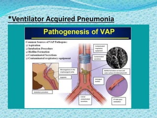 *Ventilator Acquired Pneumonia
 