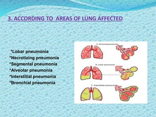 3. ACCORDING TO AREAS OF LUNG AFFECTED
*Lobar pneumonia
*Necrotizing pneumonia
*Segmental pneumonia
*Alveolar pneumonia
*Interstitial pneumonia
*Bronchial pneumonia
 
