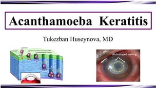 Acanthamoeba Keratitis
chalky white infiltrates
Ring infiltrate
Stromal necrosis and
central thinning
Tukezban Huseynova, MD
 