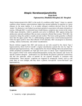 Atopic Keratoconjunctivitis
Raju Kaiti
Optometrist, Dhulikhel Hospital, KU Hospital
Atopic keratoconjunctivitis (AKC) is the result of a condition called "atopy". Atopy is a genetic
condition where immune system produces higher than normal antibodies in response to a given
allergen. As the name implies, it is an atopic (allergic) condition (derived from the Greek
‘atopos’ for aberrant or out of place) occurring in patients in association with atopic dermatitis or
eczema. Although AKC is a perennial (year round) disease, symptoms may worsen in the winter.
Unlike atopic dermatitis, which is generally seen early in childhood, AKC appears during late
adolescence and early adulthood. Men are more commonly affected than women. With AKC, the
conjunctiva lining the eyelids is usually red and swollen. The lower eyelid generally is affected
more than the upper eyelid. This is a differentiating symptom from vernal keratoconjunctivitis
where the upper eyelid is most often affected. If left untreated, AKC can progress to ulceration,
scarring, cataract, keratoconus, and corneal vascularization.
Recent evidence suggests that AKC and eczema are not only caused by the classic Type I
hypersensitivity (from Gell & Coomb’s original classification system) but also by Type IV
(delayed-type) hypersensitivity. This is supported by the clinical findings that some patients have
neither peripheral eosinophilia nor high IgE levels (seen in classic Type I hypersensitivities),
have negative RAST tests (radio-immunoallergosorption testing that measures IgE levels for
specific common allergens – performed to try and identify the patient’s particular sensitivities)
and that this particular subset of patients do not respond favorably to treatment with
antihistamines. These patients’ symptoms are triggered by nonspecific stimuli, such as cold
wind, dust, or even sunlight, and they show a general, non-specific ‘across-the-board’ type
hypersensitivity.
Symptoms
 Sensitivity to light (photophobia)
 