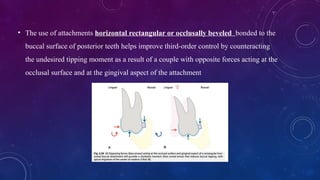 Rectangular Attachment Comprehensive Biomechanics of Orthodontic Aligners and Attachments | PPTX