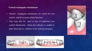 Rectangular Attachment Comprehensive Biomechanics of Orthodontic Aligners and Attachments | PPTX