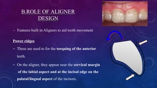 Comprehensive Biomechanics of Orthodontic Aligners and Attachments | PPTX