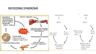 REFEEDING SYNDROME
 