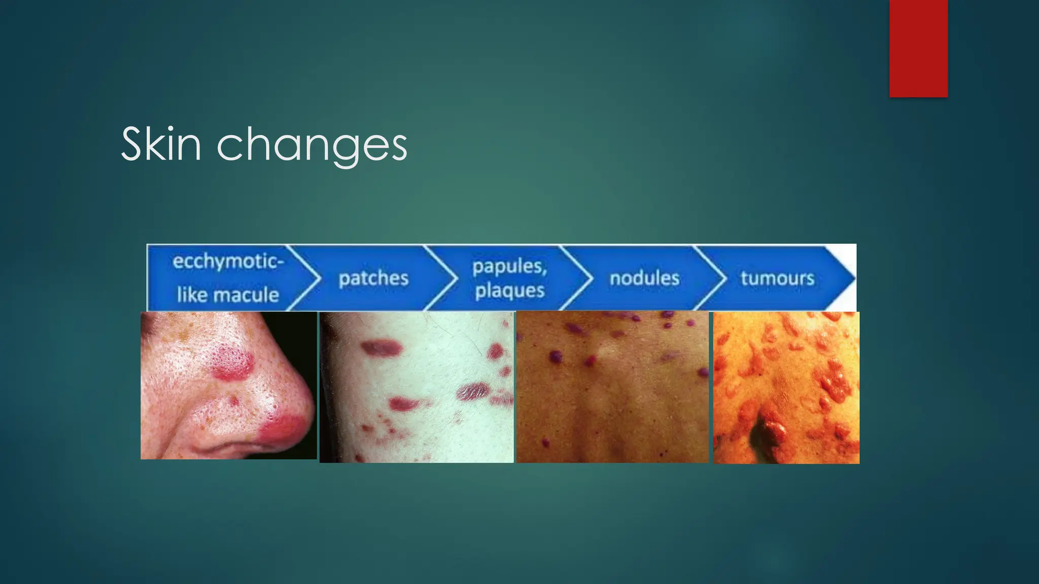 Kaposi's sarcoma medicine and surgery ppt | PPTX