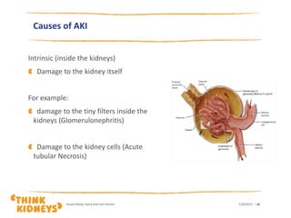 Causes of AKI
Intrinsic (inside the kidneys)
Damage to the kidney itself
For example:
damage to the tiny filters inside the
kidneys (Glomerulonephritis)
Damage to the kidney cells (Acute
tubular Necrosis)
1/26/2017Acute Kidney Injury and Care Homes | 10
 