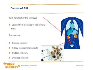 Causes of AKI
Post Renal (after the kidneys)
Caused by a blockage in the urinary
tract
For example:
Blocked catheter
Kidney stones (renal calculi)
Bladder tumours
Enlarged prostate
1/26/2017Acute Kidney Injury and Care Homes | 11
 