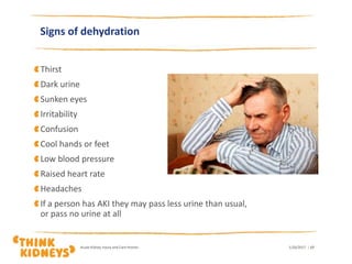 Signs of dehydration
Thirst
Dark urine
Sunken eyes
Irritability
Confusion
Cool hands or feet
Low blood pressure
Raised heart rate
Headaches
If a person has AKI they may pass less urine than usual,
or pass no urine at all
1/26/2017Acute Kidney Injury and Care Homes | 17
 