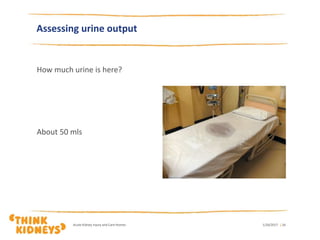 How much urine is here?
About 50 mls
1/26/2017Acute Kidney Injury and Care Homes | 24
Assessing urine output
 