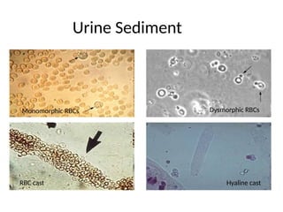 Monomorphic Rbc Comprehensive Overview of Acute Kidney Injury: Definitions ...