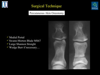 Surgical Technique Medial Portal Swann-Morton Blade MS67 Large Shannon Straight Wedge Burr if necessary… Percutaneous Akin Osteotomy 