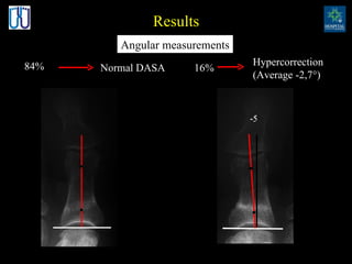 Results Normal DASA 84% 16% Hypercorrection (Average -2,7°) Angular measurements 