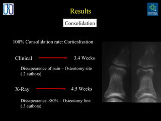 Results 100% Consolidation rate: Corticalisation Consolidation Clinical X-Ray 3.4 Weeks Dissapearence of pain – Osteotomy site ( 2 authors) Dissapearence >80% – Osteotomy line ( 3 authors) 4.5 Weeks 