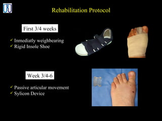 Rehabilitation Protocol Inmediatly weighbearing Rigid Insole Shoe Passive articular movement Sylicon Device First 3/4 weeks Week 3/4-6 