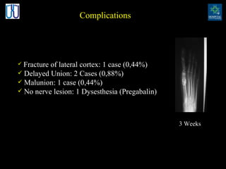 Complications Fracture of lateral cortex: 1 case (0,44%) Delayed Union: 2 Cases (0,88%) Malunion:  1 case (0,44%) No nerve lesion: 1 Dysesthesia (Pregabalin) 3 Weeks 