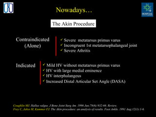 Nowadays… Contraindicated (Alone) Severe  metatarsus primus varus Incongruent 1st metatarsophalangeal joint Severe Athritis Coughlin MJ .   Hallux valgus.   J Bone Joint Surg Am. 1996 Jun;78(6):932-66. Review.  Frey C, Jahss M, Kummer FJ.   The Akin procedure: an analysis of results.   Foot Ankle. 1991 Aug;12(1):1-6. Indicated Mild HV without metatarsus primus varus HV with large medial eminence HV interphalangeus Increased  Distal Articular Set Angle (DASA)   The Akin Procedure 