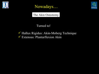 Nowadays… Hallux Rigidus: Akin-Moberg Technique Extensus: Plantarflexion Akin The Akin Osteotomy Turned to! 