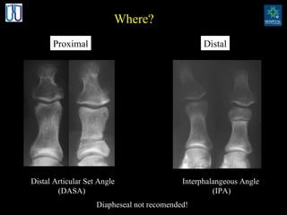 Where? Proximal Distal Distal Articular Set Angle (DASA) Interphalangeous Angle (IPA) Diapheseal not recomended! 