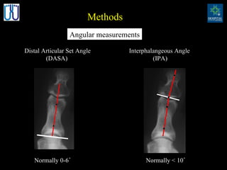 Methods Distal Articular Set Angle (DASA) Angular measurements Interphalangeous Angle (IPA) Normally 0-6˚ Normally < 10˚ 