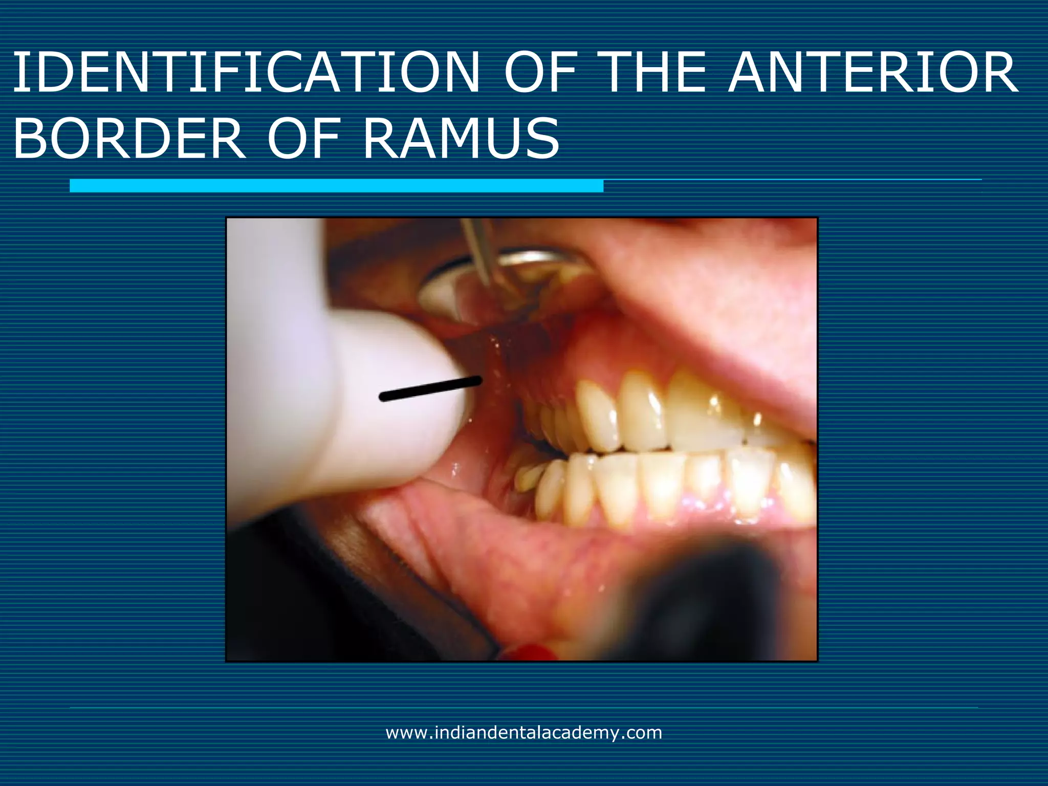 Akinosi & gow gates nerve blocks / prosthodontic courses | PPT | Ear ...