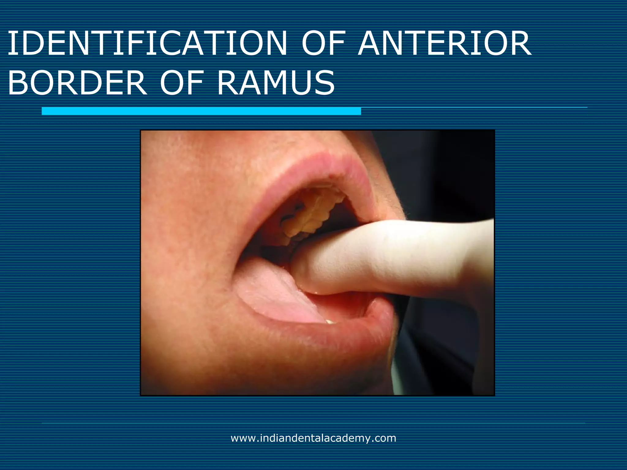 Akinosi & gow gates nerve blocks / prosthodontic courses | PPT | Ear ...