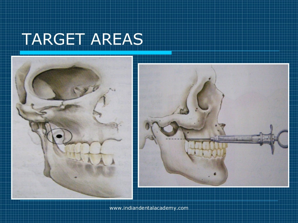 Akinosi & gow gates nerve blocks / prosthodontic courses