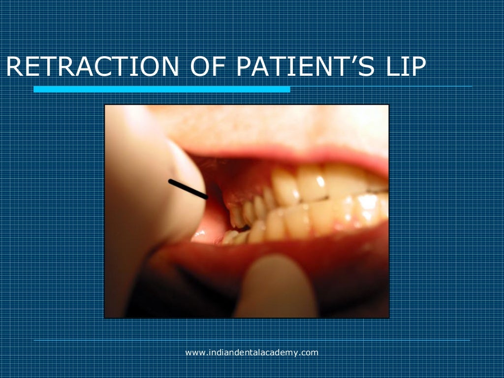 Akinosi & gow gates nerve blocks / prosthodontic courses