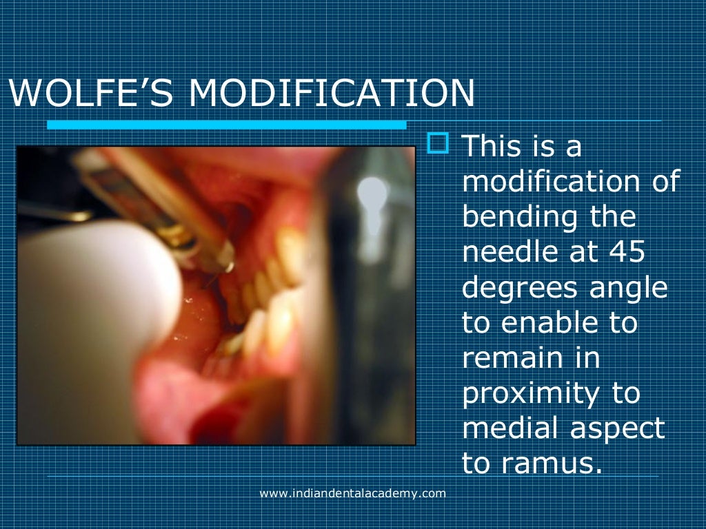Akinosi & gow gates nerve blocks / prosthodontic courses