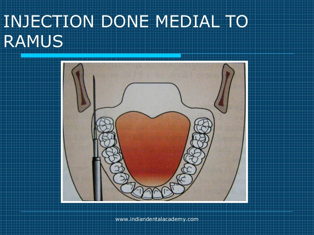 Akinosi & gow gates nerve blocks / prosthodontic courses