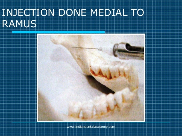 Akinosi & gow gates nerve blocks / prosthodontic courses