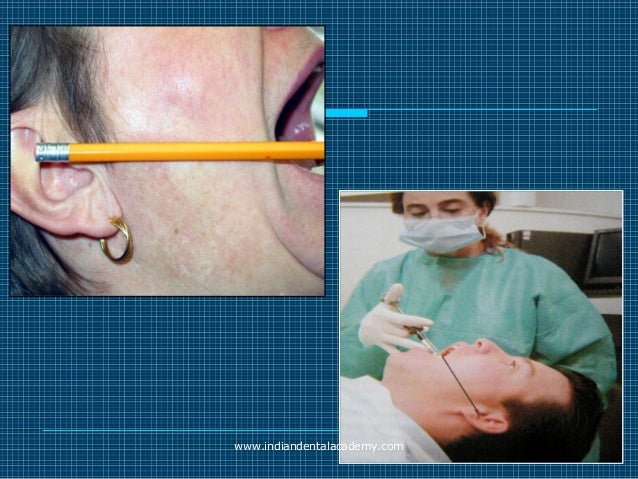 Akinosi & gow gates nerve blocks / prosthodontic courses