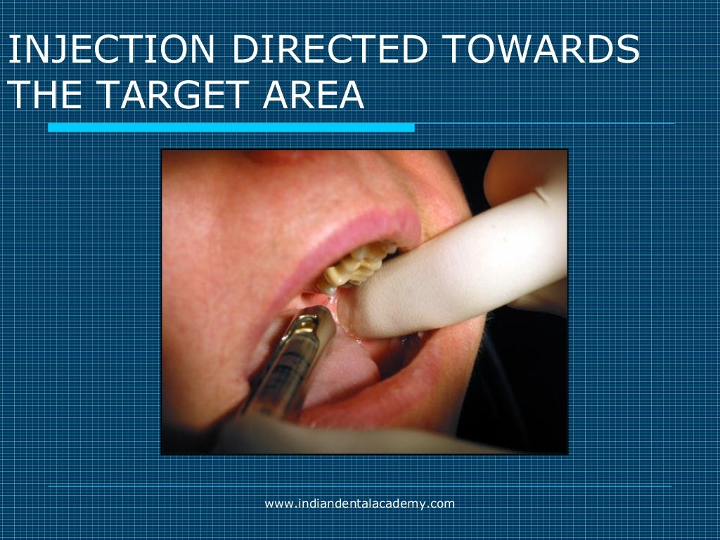 Akinosi & gow gates nerve blocks / prosthodontic courses