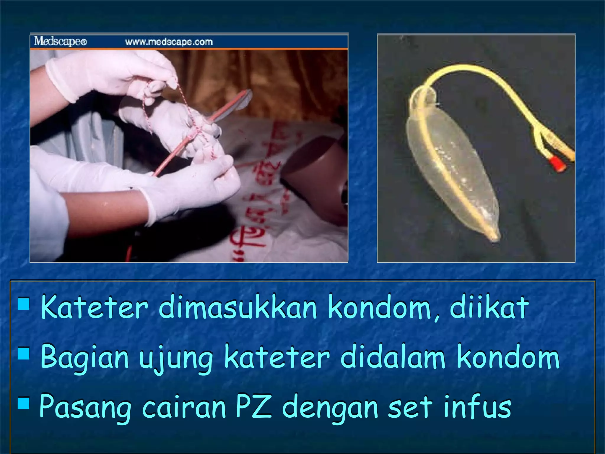    Kateter dimasukkan kondom, diikat
   Bagian ujung kateter didalam kondom
   Pasang cairan PZ dengan set infus
 