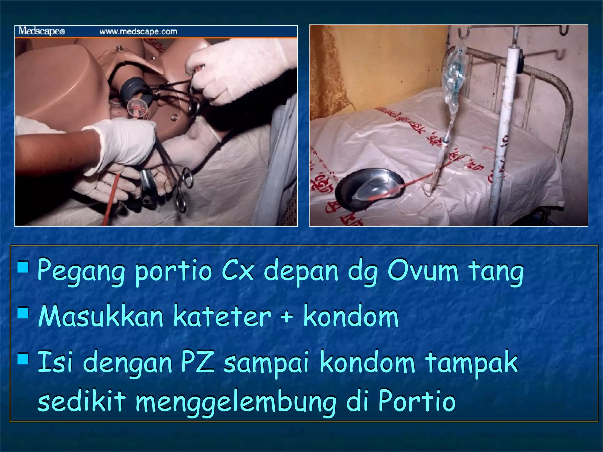   Pegang portio Cx depan dg Ovum tang
   Masukkan kateter + kondom
   Isi dengan PZ sampai kondom tampak
    sedikit menggelembung di Portio
 
