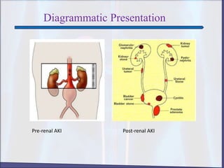 Diagrammatic Presentation
Pre-renal AKI Post-renal AKI
 