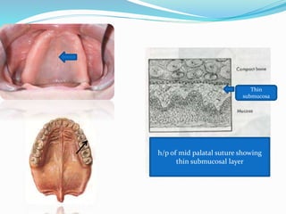 Thin
submucosa
h/p of mid palatal suture showing
thin submucosal layer
 