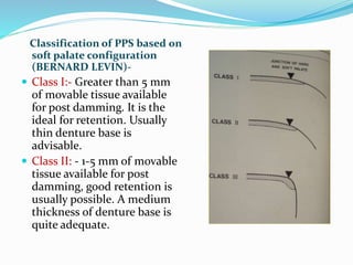 Classification of PPS based on
soft palate configuration
(BERNARD LEVIN)-
 Class I:- Greater than 5 mm
of movable tissue available
for post damming. It is the
ideal for retention. Usually
thin denture base is
advisable.
 Class II: - 1-5 mm of movable
tissue available for post
damming, good retention is
usually possible. A medium
thickness of denture base is
quite adequate.
 