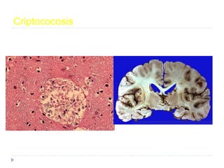 Meningitis Crónica
Radiología
IRM con contraste.
TACC espinal. IRM espinal.
Angiografía.
Biopsia
Leptomeninges/cerebral.
M...