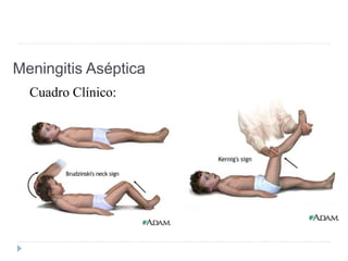 Meningitis Aséptica
Cuadro Clínico:
 