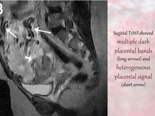 Sagittal T2WI showed
multiple dark
placental bands
(long arrows) and
heterogeneous
placental signal
(short arrow)
 
